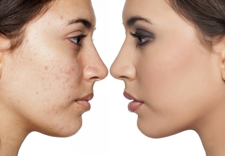 Black Spots Acne Scars | Chemical Skin Peel Treatment