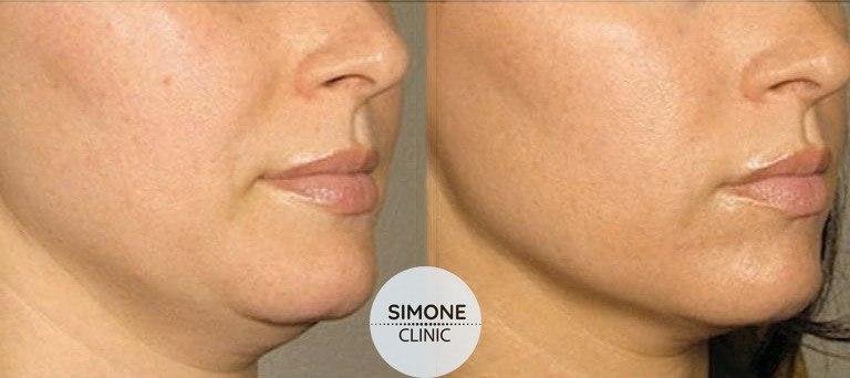 Aqualyx Fat Dissolving Injections | Beauty Clinic Simone